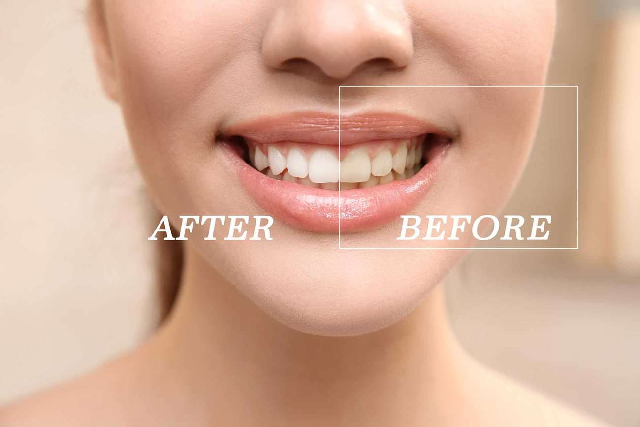 How Can You Maintain a Consistent Smile Shade with Crowns Brighton?