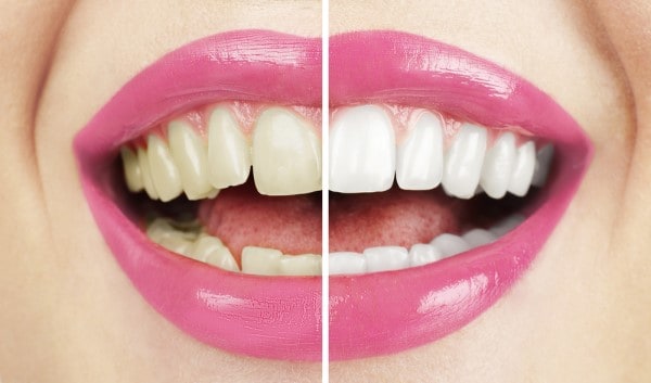 What Makes Ultima White Teeth Whitening Different Brighton