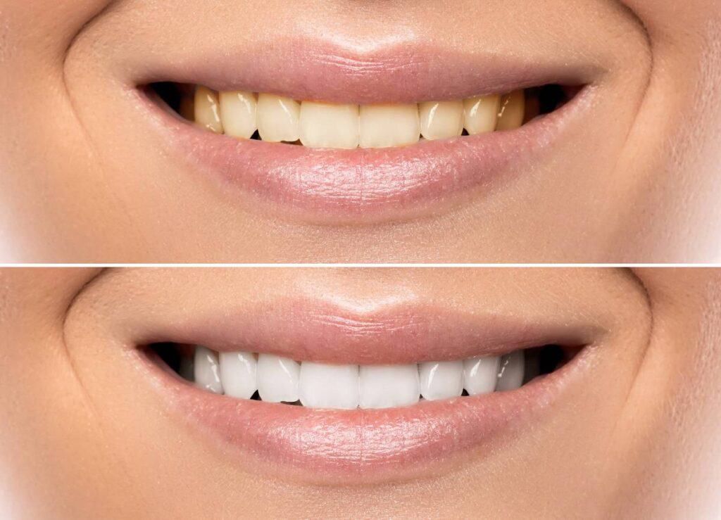 How Can You Protect Your White Smile as a Coffee Lover Brighton?
