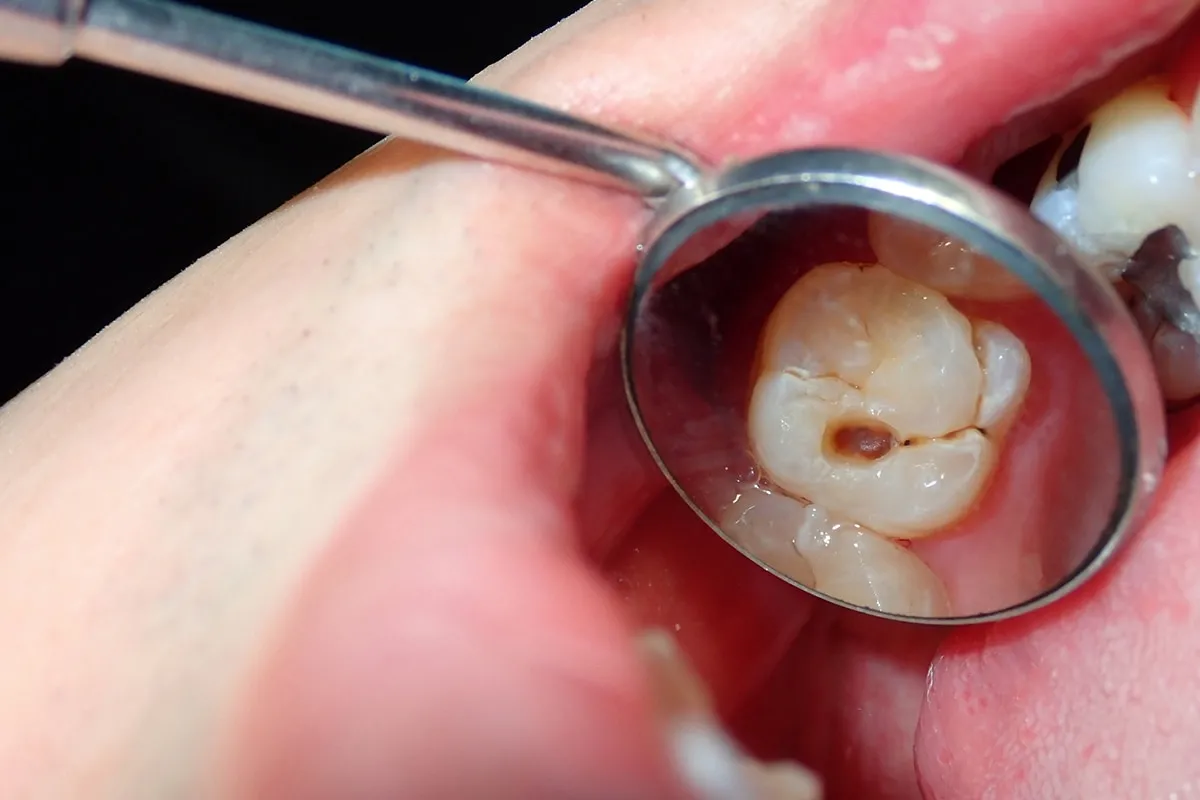 Why Do Teeth Crack? Common Causes to Know Brighton