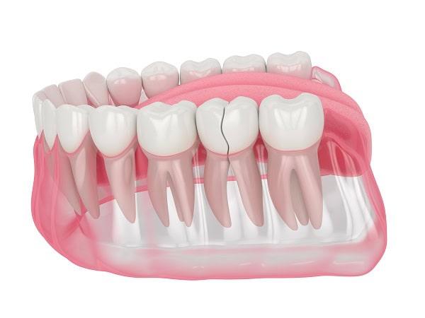 How Can You Manage Pain and Discomfort After a Root Canal Brighton?