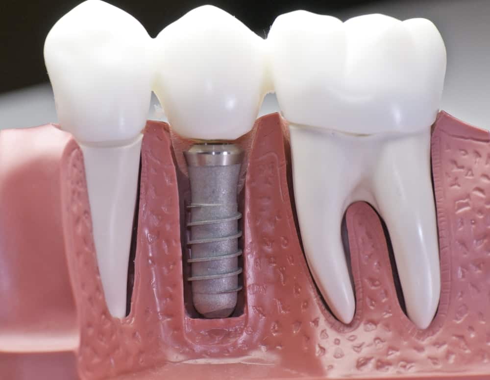 Common Misconceptions About Modern Dental Treatments Brighton