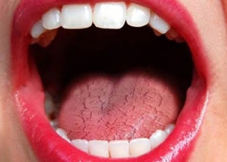 Common Causes of Dry Mouth (Xerostomia) Brighton