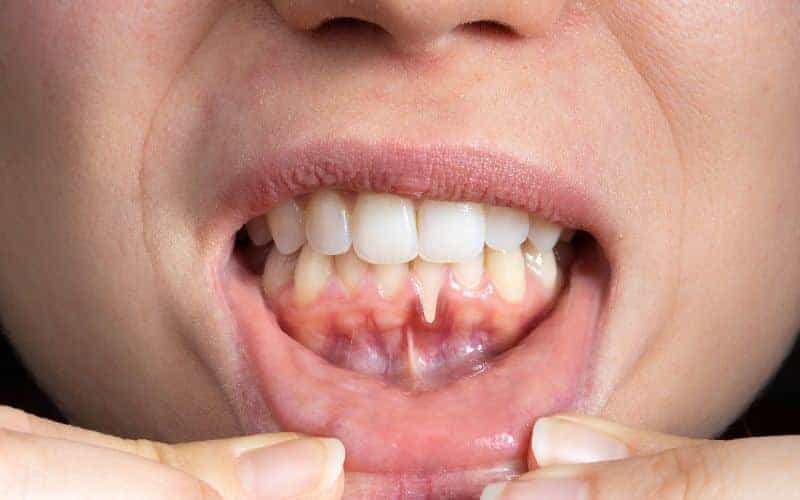 How Can Gum Disease Be Prevented Brighton?