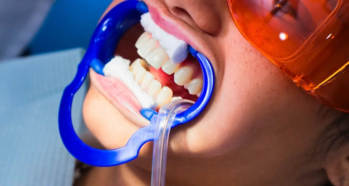 What Side Effects Can You Experience After Laser Teeth Whitening Brighton?