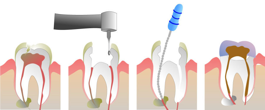 How Do You Properly Care for Your Teeth After a Root Canal Brighton