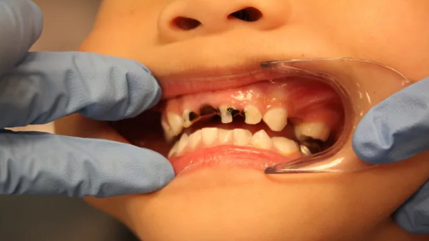 Tips for Keeping Your Child’s Baby Teeth Healthy and Strong Brighton