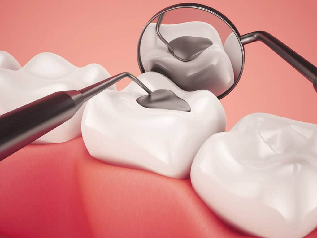 Fighting Cavities and Plaque Buildup Brighton