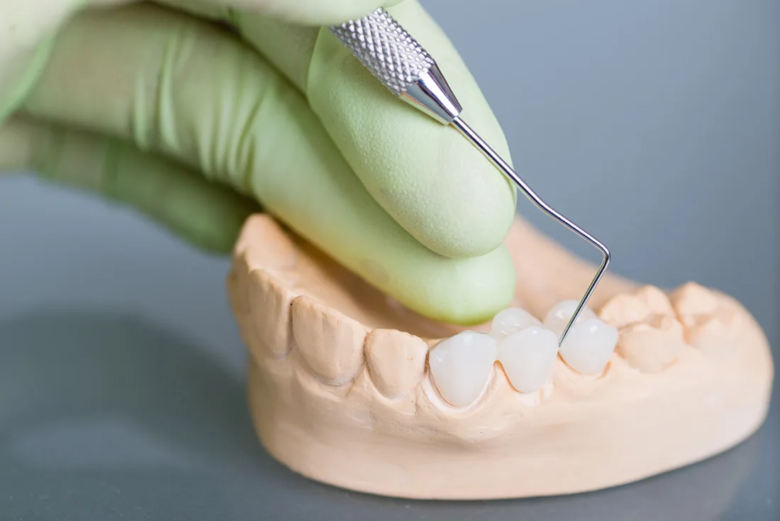 What Are the Different Types of Dental Crowns Available Brighton?