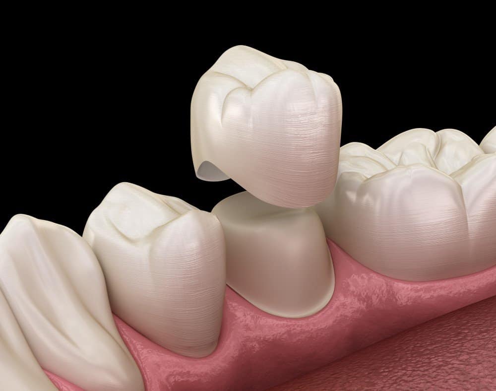 What Daily Habits Help Protect Your Dental Crowns Brighton?